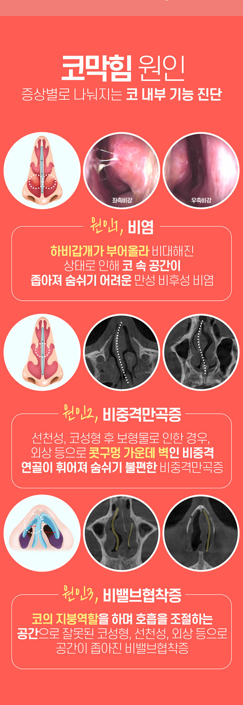 웨이브의원 웨이브 😪비염코성형😪 이벤트, 시술 상세 이미지