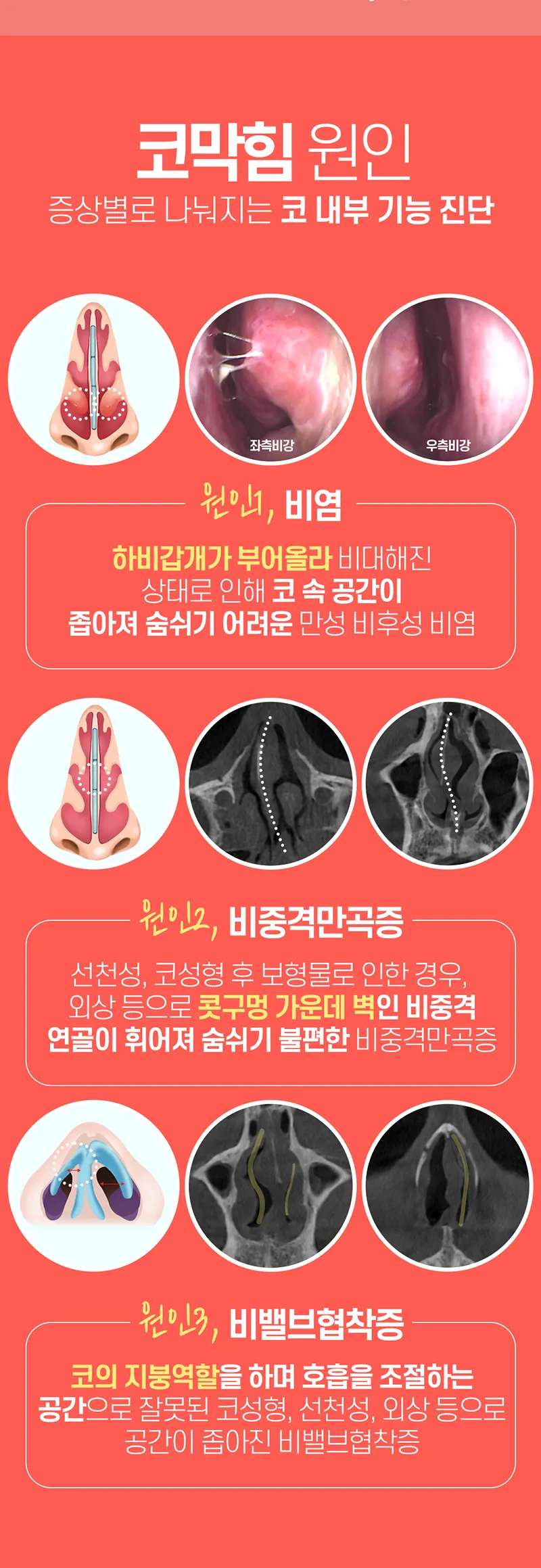 웨이브의원 웨이브 😪비염코성형😪 이벤트, 시술 상세 이미지