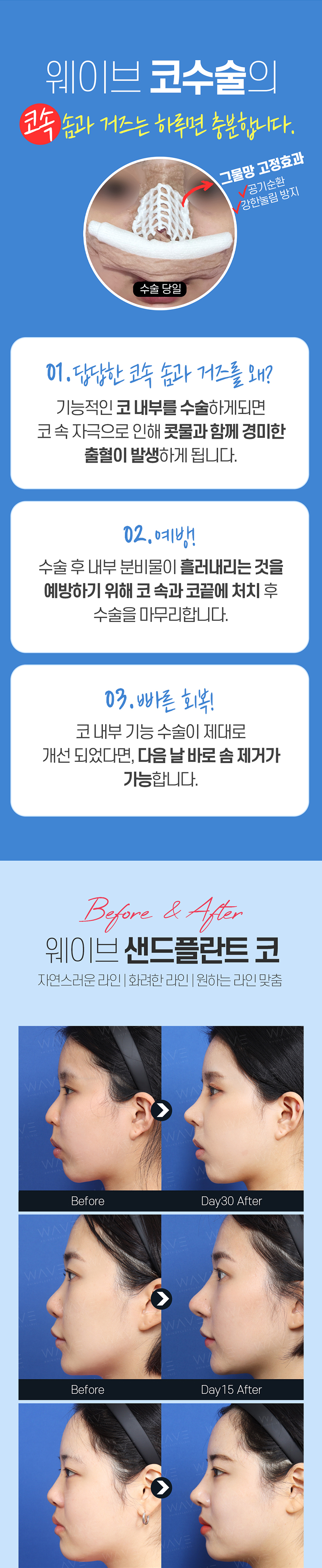 웨이브의원 무보형물 특허🥇 샌드플란트 코성형 이벤트, 시술 상세 이미지