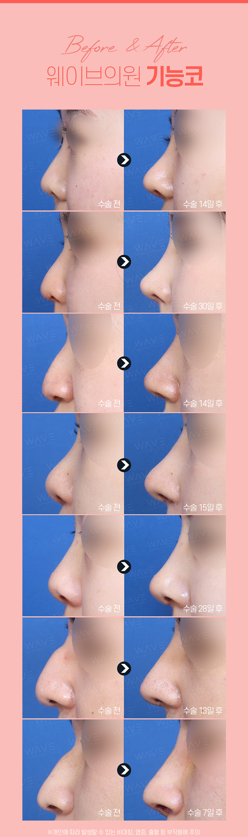 웨이브의원 웨이브 😪비염코성형😪 이벤트, 시술 상세 이미지