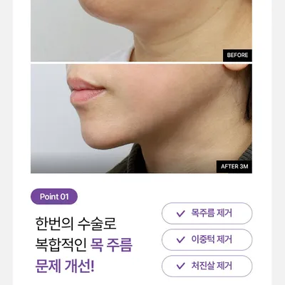 에이탑성형외과 이중턱&목 리프팅 이벤트, 시술 상세 이미지