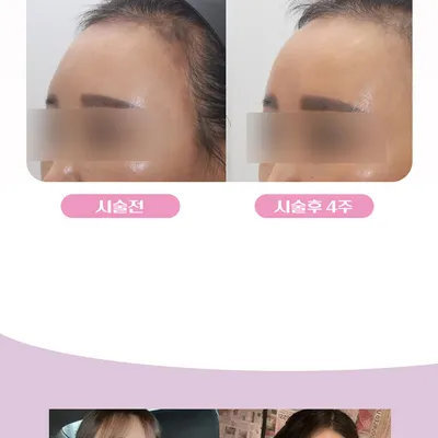 꿈꾸는성형외과의원 꿈꾸는 볼륨 이마필러 이벤트 이벤트, 시술 상세 이미지