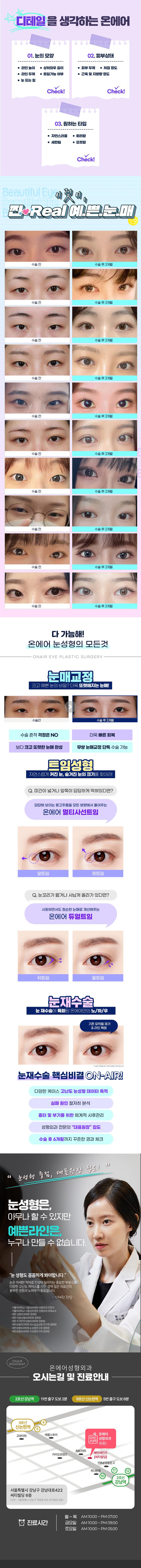 온에어성형외과 예쁜 눈은 💘 온에어 이벤트, 시술 상세 이미지