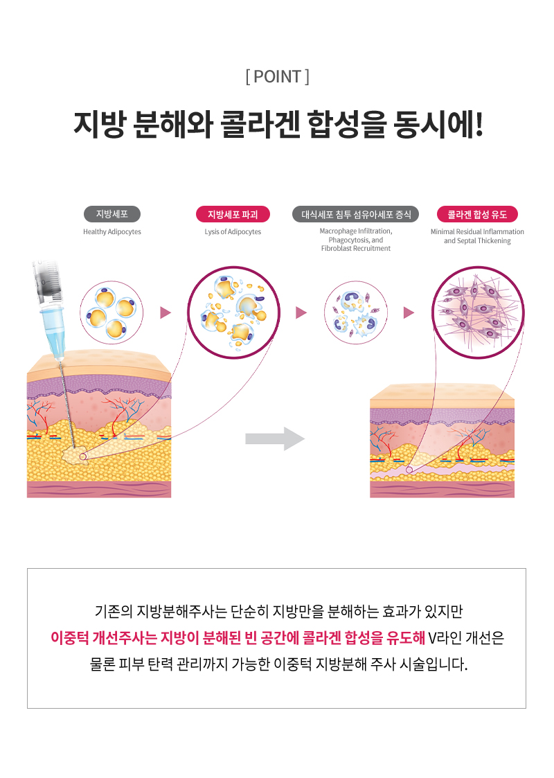 유앤아이의원 선릉점 이중턱 개선주사 이벤트, 시술 상세 이미지