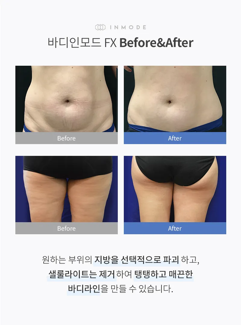 유앤아이의원 영등포점 영등포) 매끄러운 바디라인 바디인모드 이벤트, 시술 상세 이미지