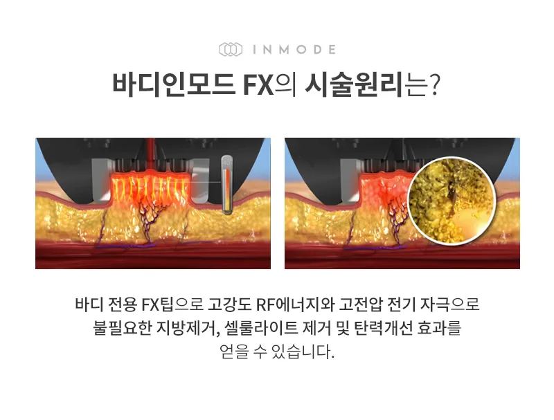 유앤아이의원 영등포점 영등포) 매끄러운 바디라인 바디인모드 이벤트, 시술 상세 이미지