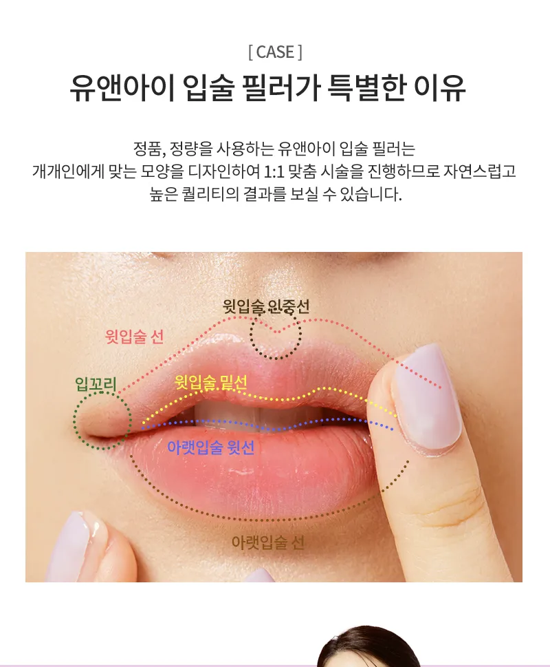 유앤아이의원 일산점 일산) 탱탱 볼륨 필러 이벤트, 시술 상세 이미지
