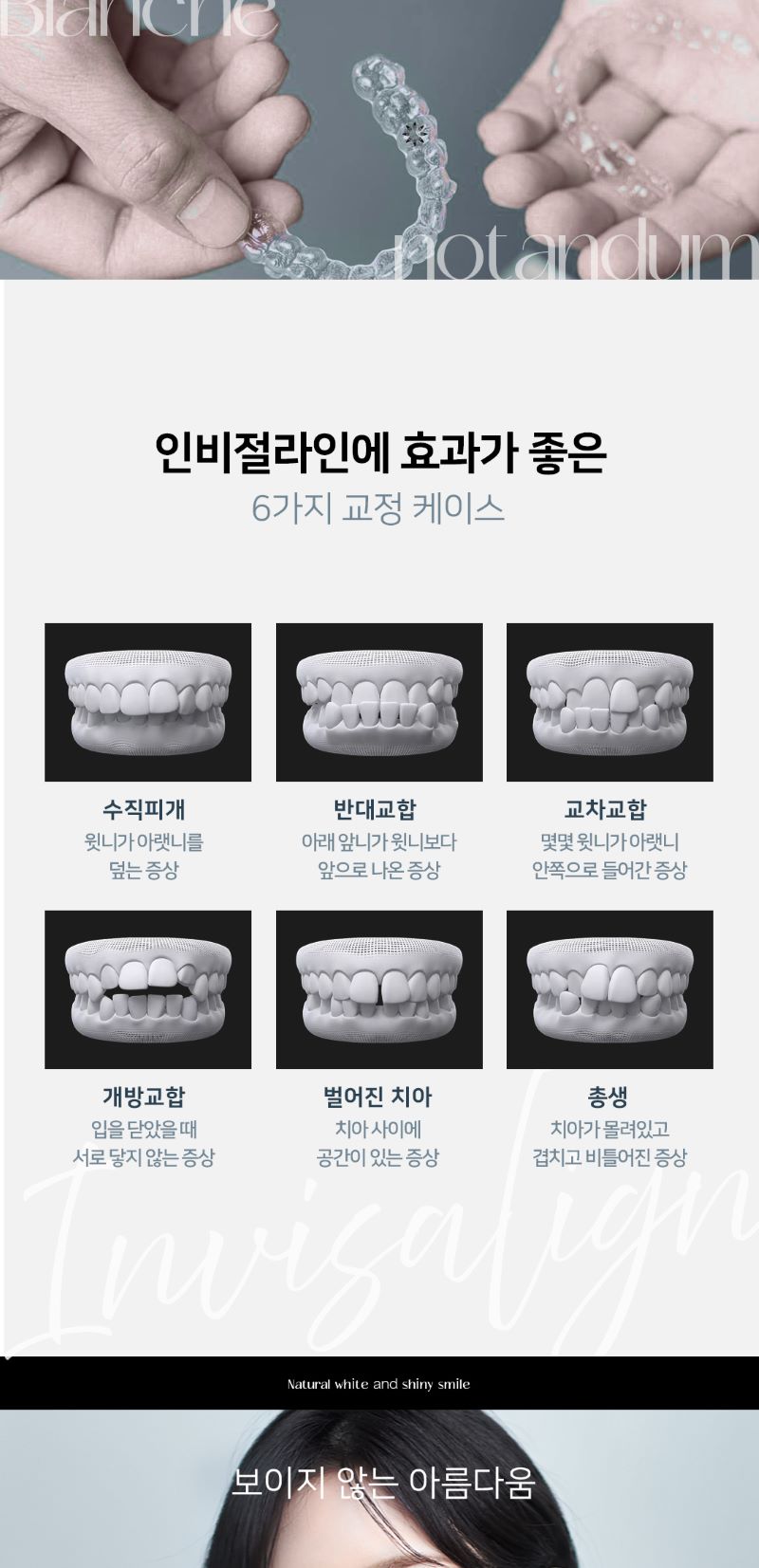 블랑쉬치과 블랑쉬 투명교정 인비절라인 이벤트, 시술 상세 이미지