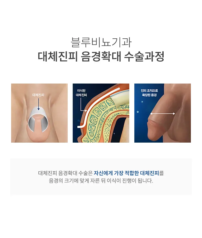 블루비뇨기과 판교점 판교) 대체진피 확대수술 EVENT 이벤트, 시술 상세 이미지
