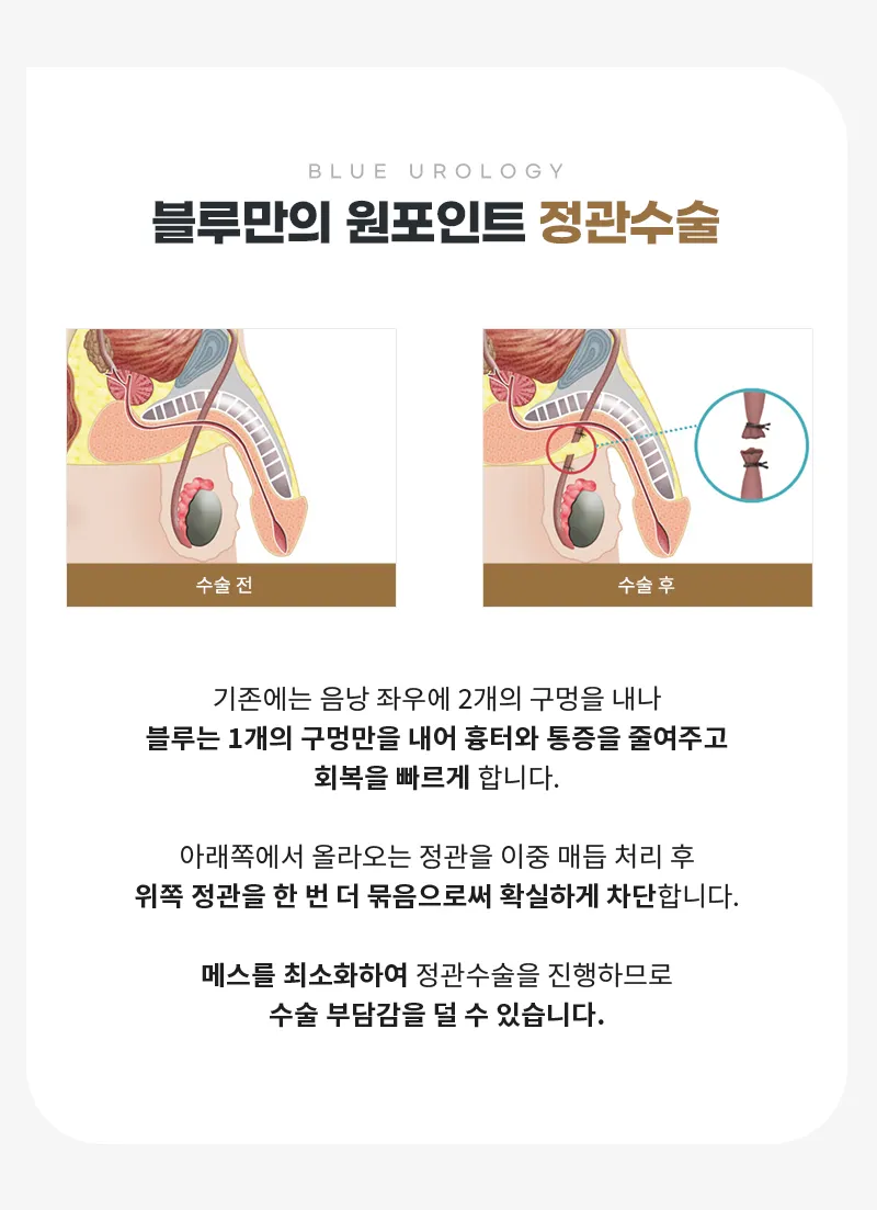 블루비뇨기과 광교점 광교) 무도정관수술 EVENT 이벤트, 시술 상세 이미지