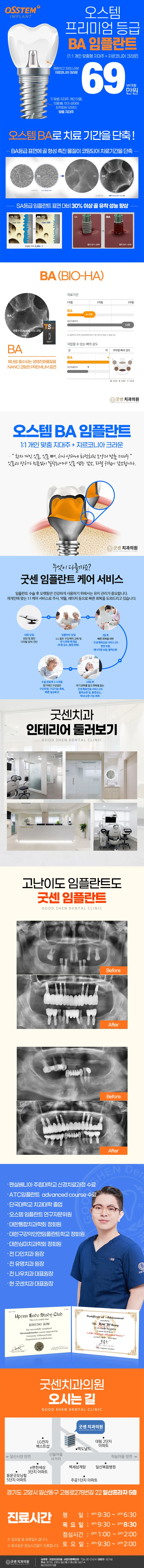 굿센치과의원 굿센 오스템 BA 임플란트 이벤트, 시술 상세 이미지