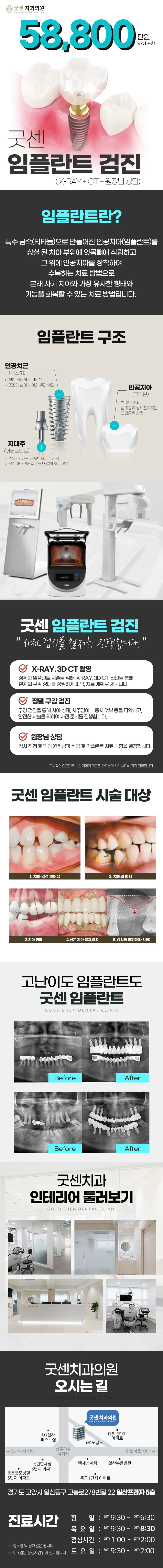 굿센치과의원 굿센 임플란트 검진 이벤트, 시술 상세 이미지