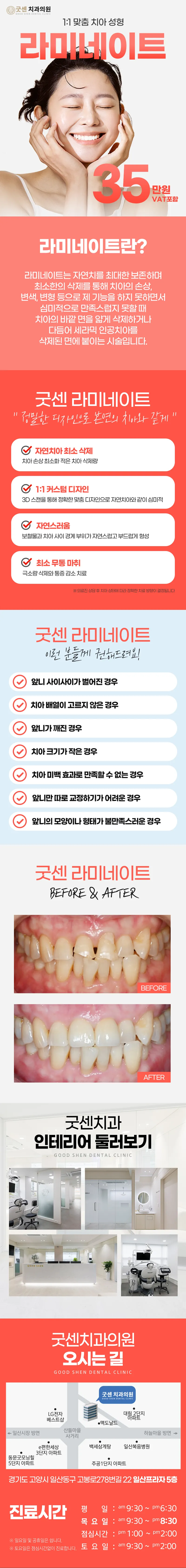 굿센치과의원 1:1 맞춤 치아 성형 굿센 라미네이 이벤트, 시술 상세 이미지