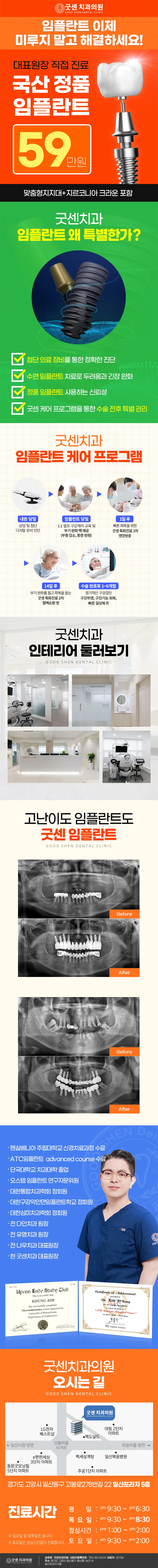 굿센치과의원 굿센 임플란트 이벤트, 시술 상세 이미지