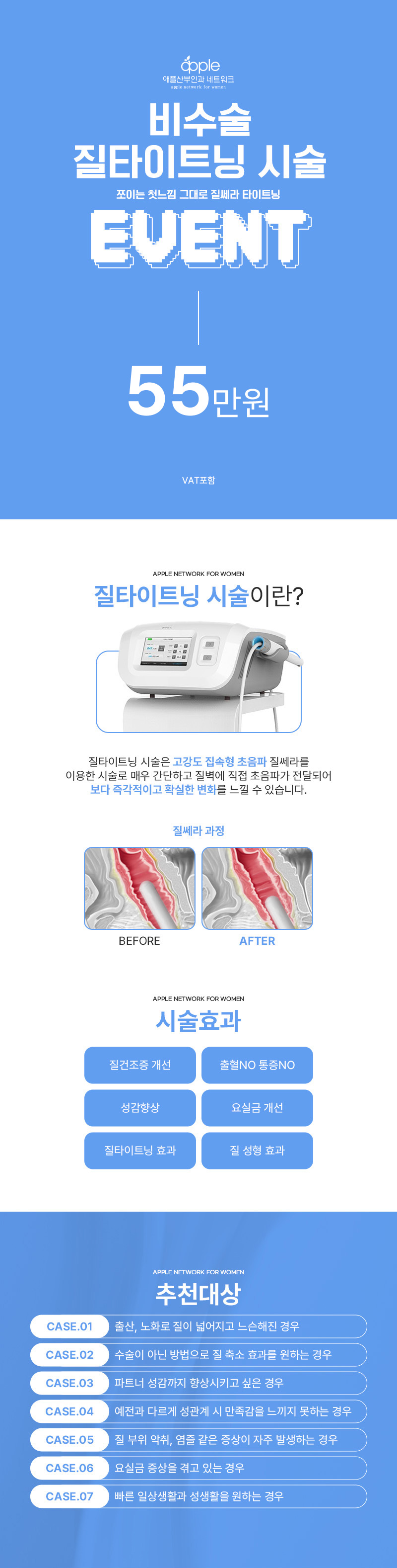 애플산부인과의원 위례 [위례점]비수술 쪼이는 첫느낌 질쎄라 이벤트, 시술 상세 이미지