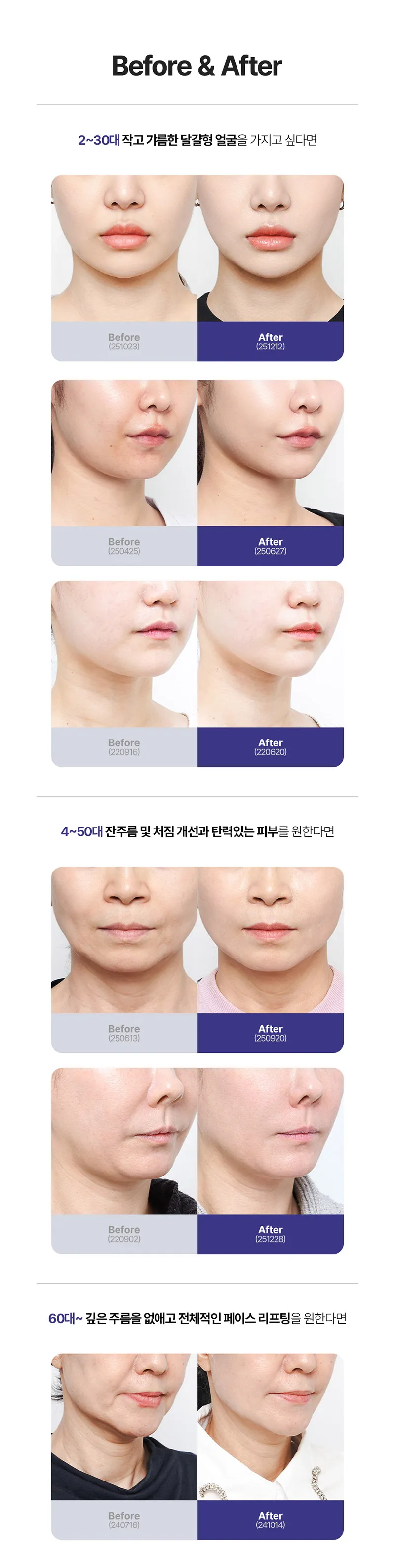 압구정비앤미의원 처짐이 느껴질때 비앤미 민트 실리프팅 이벤트, 시술 상세 이미지