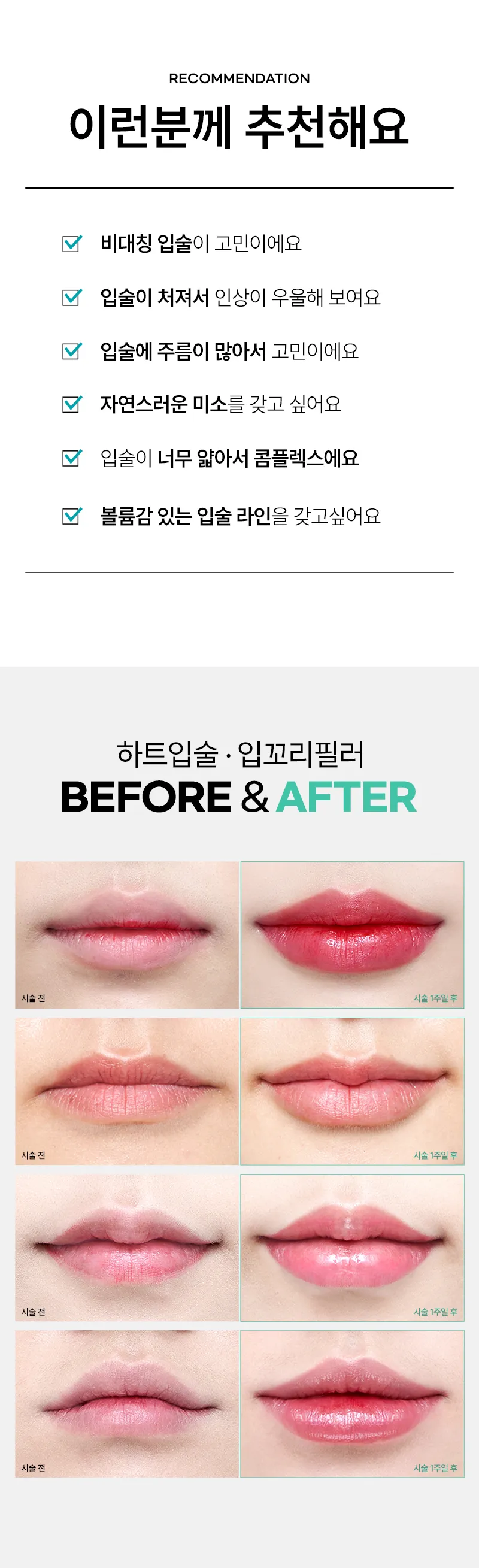 압구정비앤미의원 비앤미 입꼬리까지 완성되는 입술필러 이벤트, 시술 상세 이미지