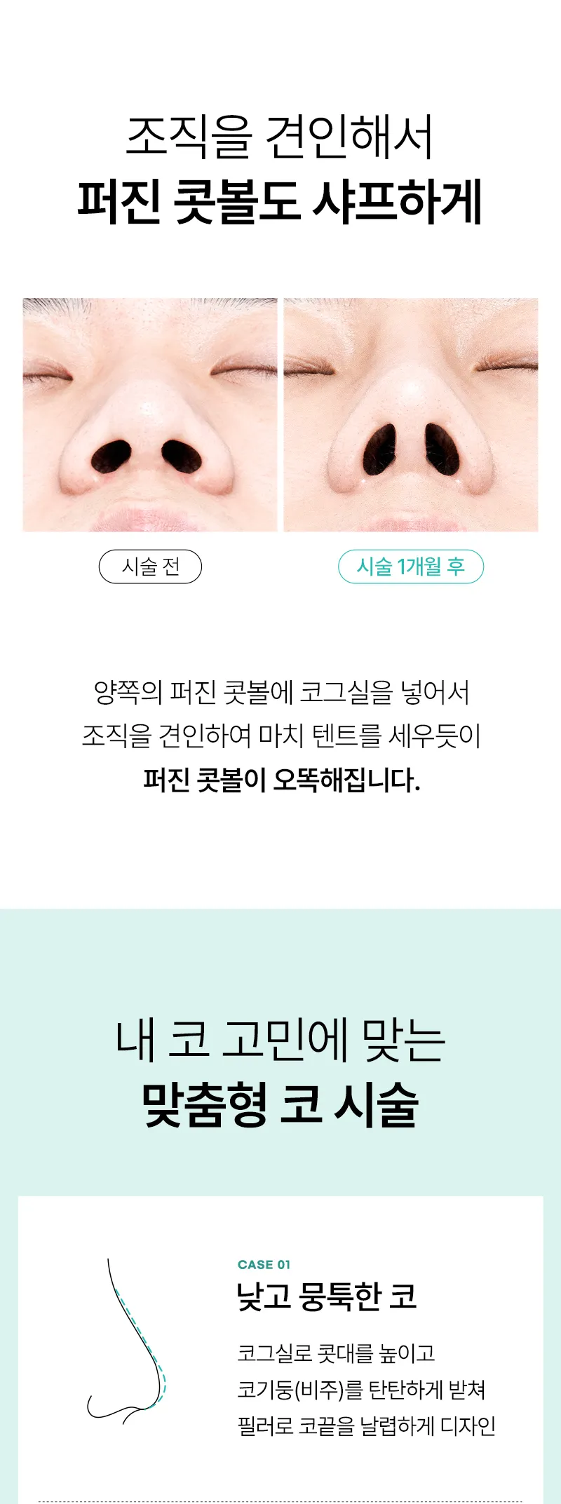 압구정비앤미의원 비앤미 오래오래 오똑하게, 미쥬코 이벤트, 시술 상세 이미지