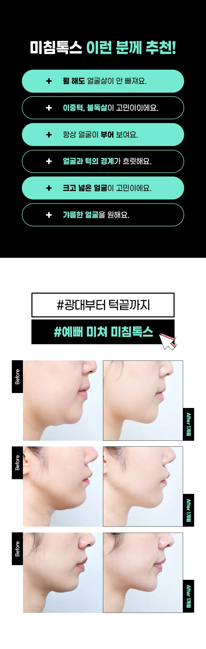 압구정비앤미의원 비앤미미침톡스,침샘or사각턱+윤곽주사 이벤트, 시술 상세 이미지