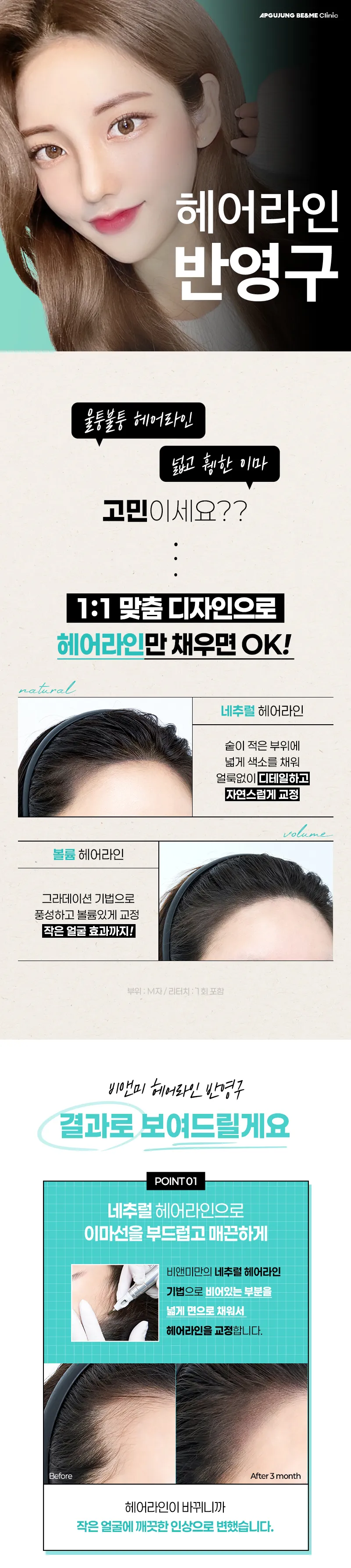 압구정비앤미의원 비앤미 헤어라인 반영구 - 리터치포함 이벤트, 시술 상세 이미지