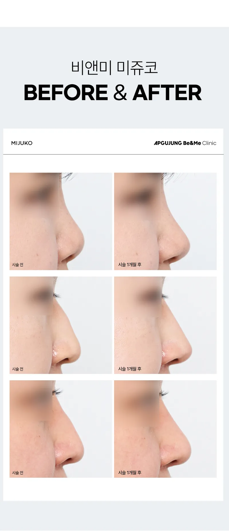 압구정비앤미의원 비앤미 오래오래 오똑하게, 미쥬코 이벤트, 시술 상세 이미지