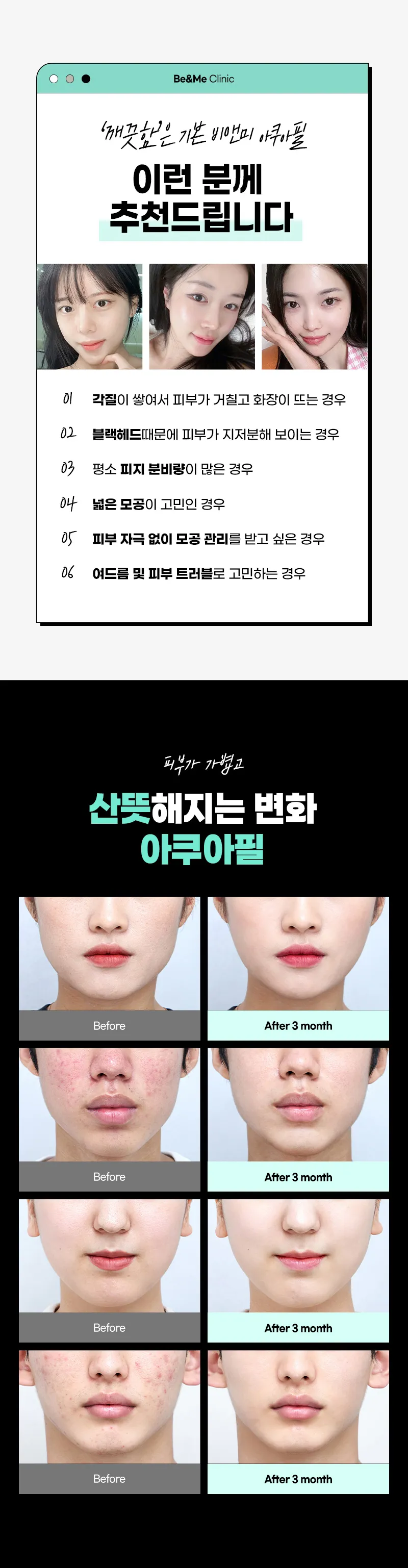 압구정비앤미의원 깨끗함부터 다른 비앤미 아쿠아필 이벤트, 시술 상세 이미지