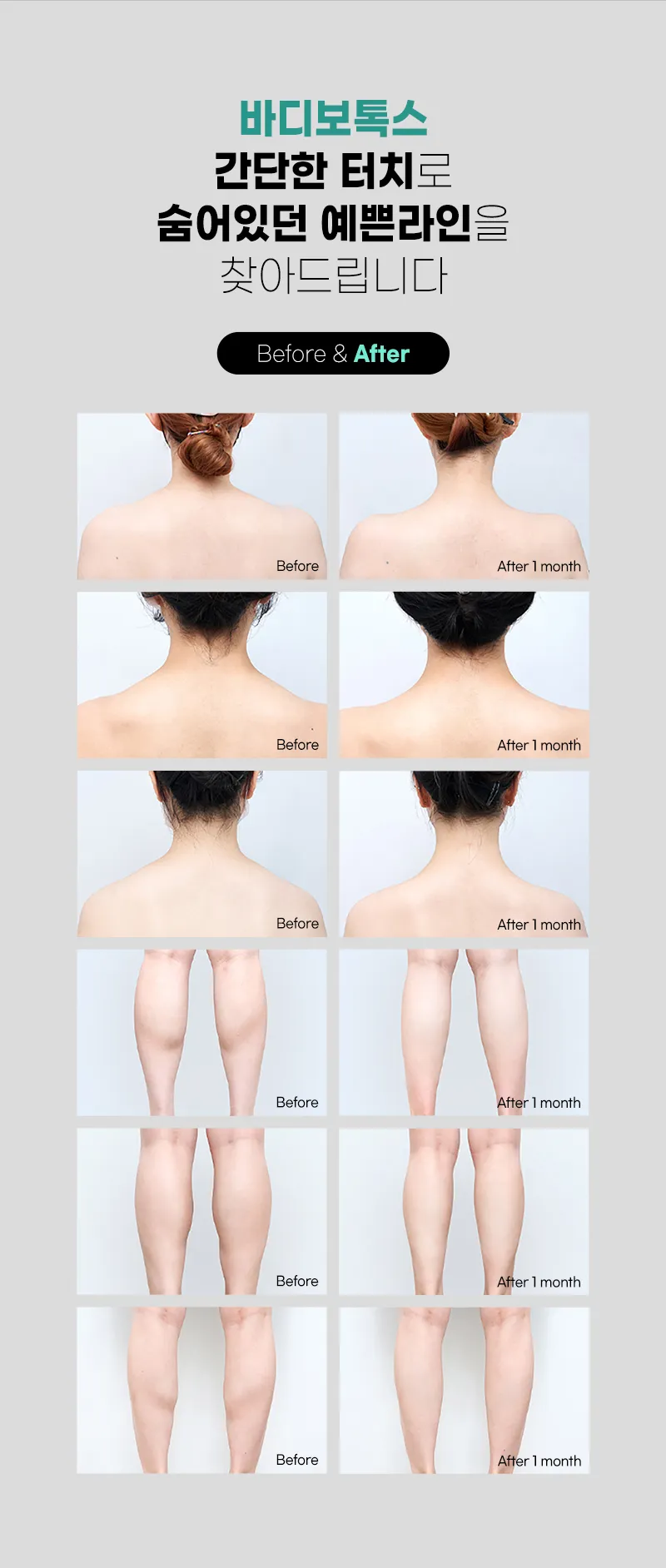 압구정비앤미의원 라인이 달라 보이는 비앤미 바디보톡스 이벤트, 시술 상세 이미지