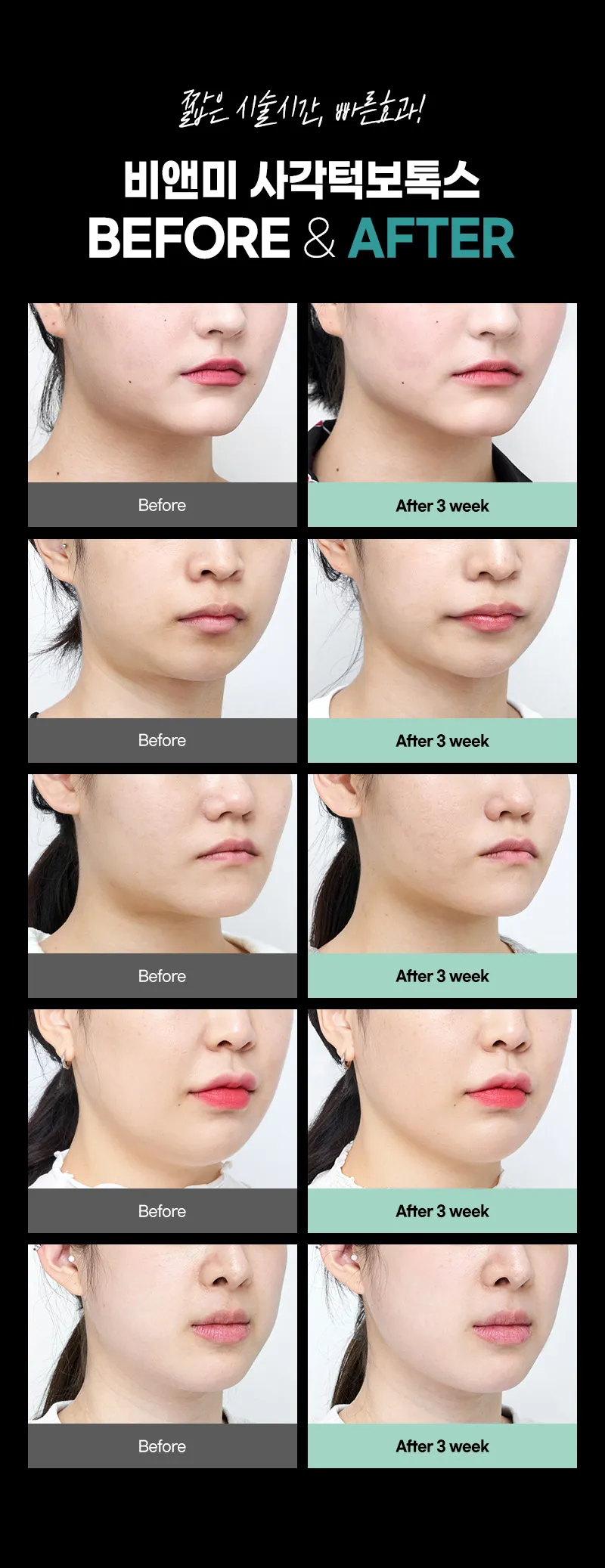 압구정비앤미의원 압구정비앤미 사각턱보톡스 V라인 이벤트, 시술 상세 이미지