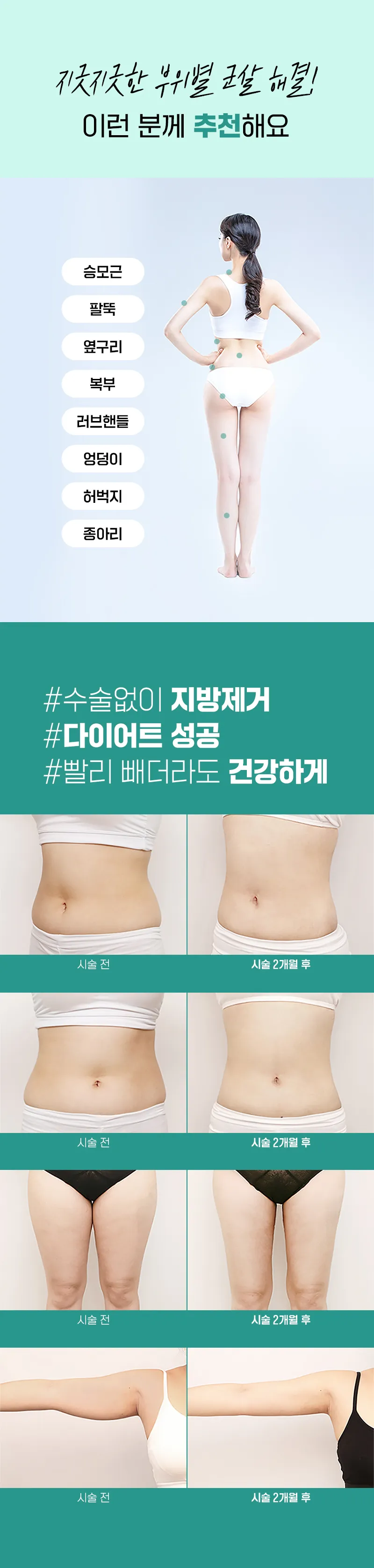 압구정비앤미의원 슬림하게 비앤미 지방분해주사 이벤트, 시술 상세 이미지