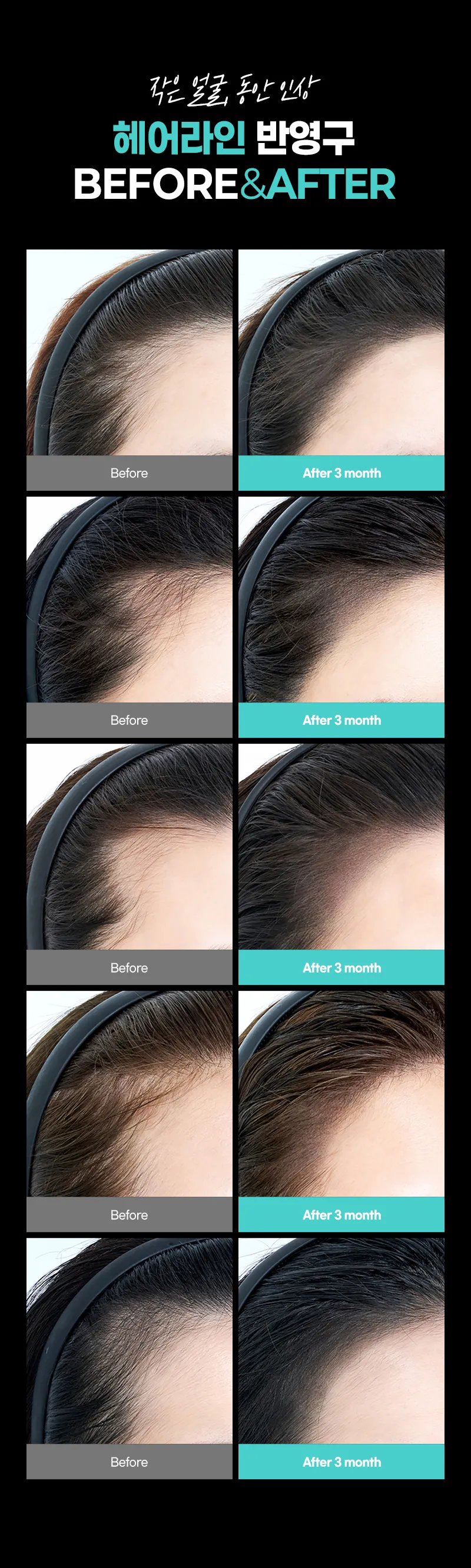 압구정비앤미의원 비앤미 헤어라인 반영구 - 리터치포함 이벤트, 시술 상세 이미지