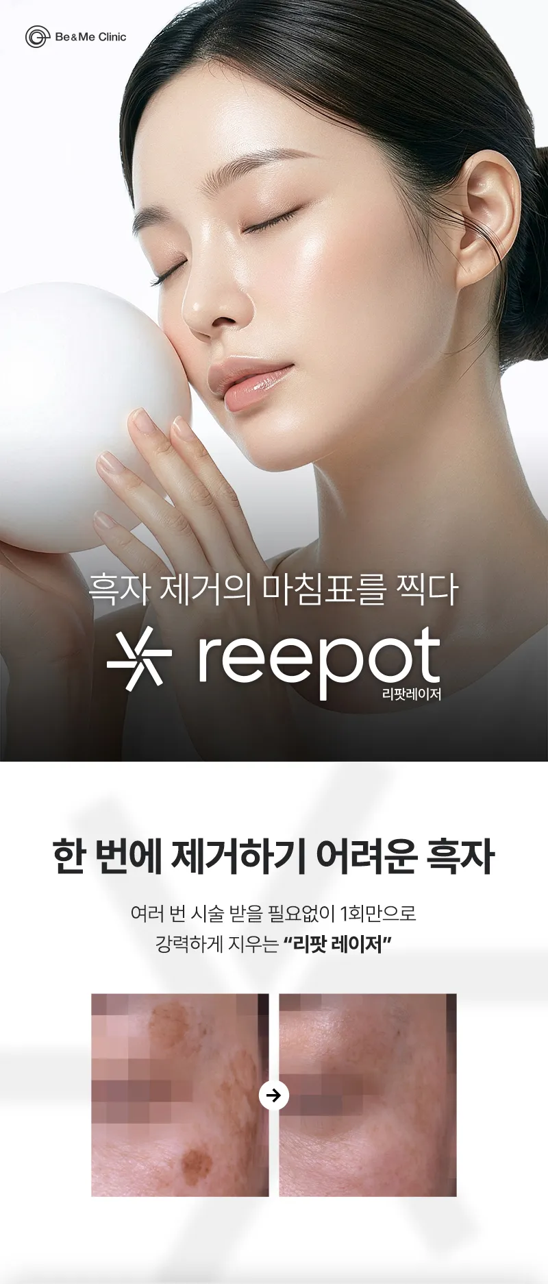 압구정비앤미의원 압구정비앤미  흑자,기미  리팟제거  이벤트, 시술 상세 이미지