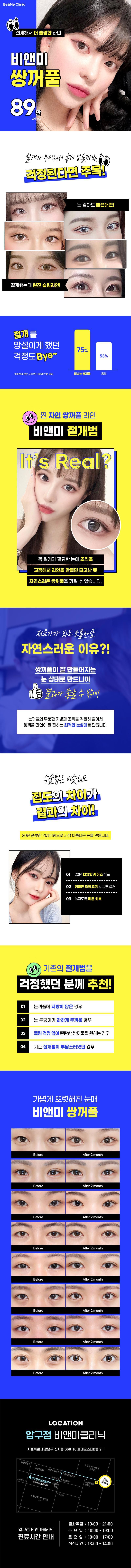 압구정비앤미의원 비앤미 쌍꺼풀 89만 이벤트, 시술 상세 이미지