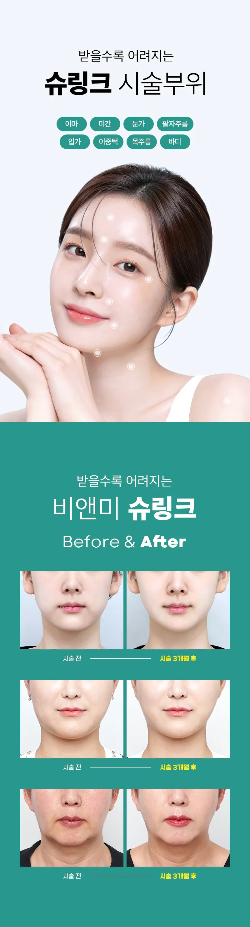 압구정비앤미의원 비앤미 슈링크 리프팅 이벤트, 시술 상세 이미지