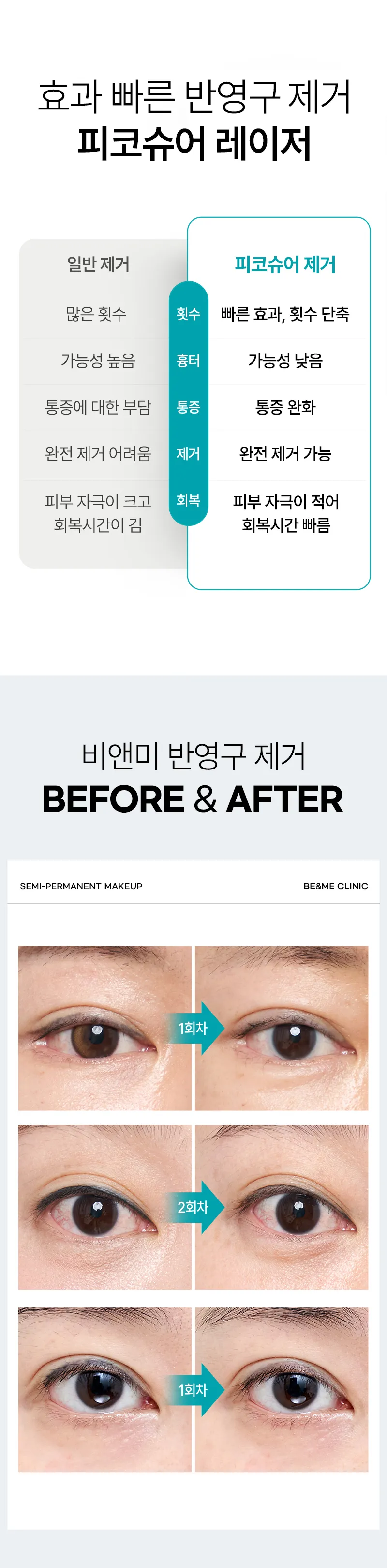 압구정비앤미의원 비앤미 아이라인 반영구 문신제거 이벤트, 시술 상세 이미지