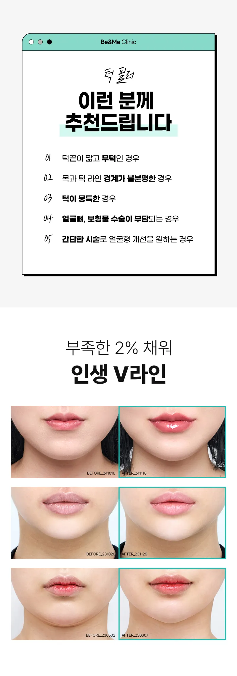 압구정비앤미의원 비앤미 앞턱 V필러 이벤트, 시술 상세 이미지