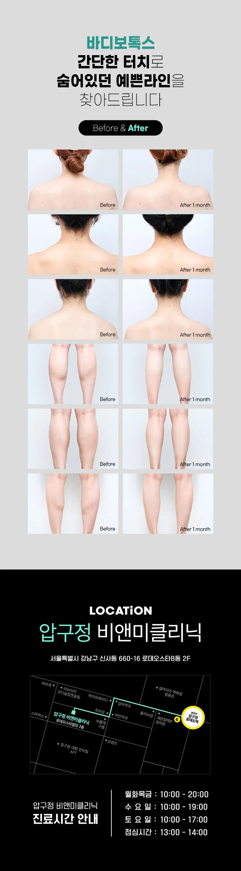 압구정비앤미의원 라인이 달라 보이는 비앤미 바디보톡스 이벤트, 시술 상세 이미지
