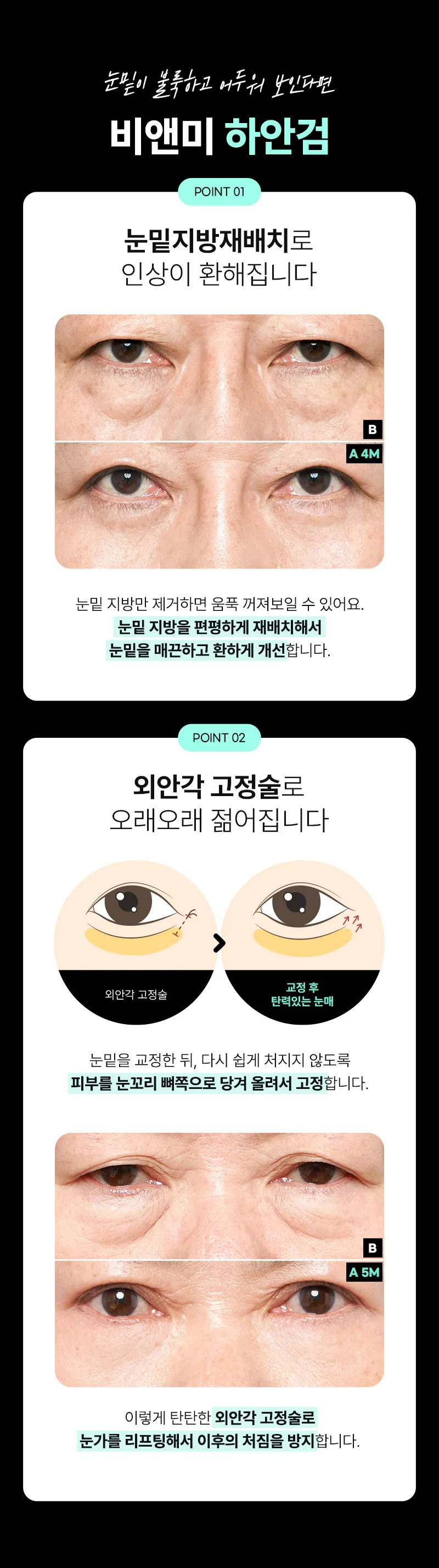 압구정비앤미의원 압구정비앤미 중년 상안검 하안검  이벤트, 시술 상세 이미지