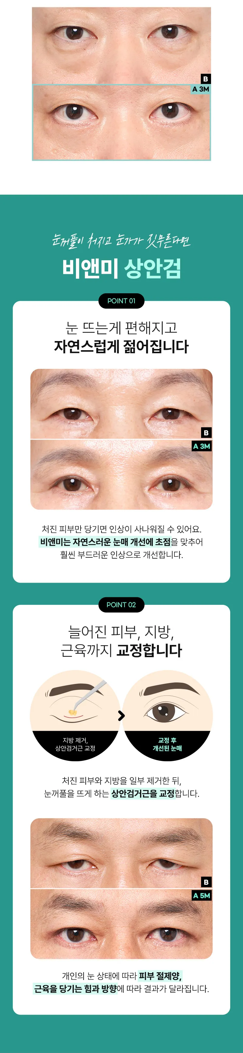 압구정비앤미의원 압구정비앤미 중년 상안검 하안검  이벤트, 시술 상세 이미지