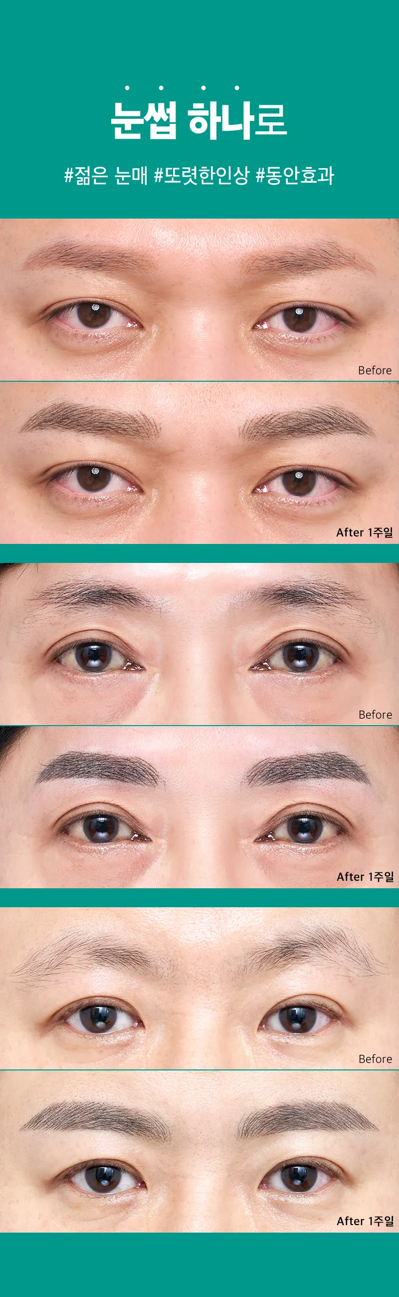 압구정비앤미의원 중년눈썹반영구도 비앤미에서 이벤트, 시술 상세 이미지