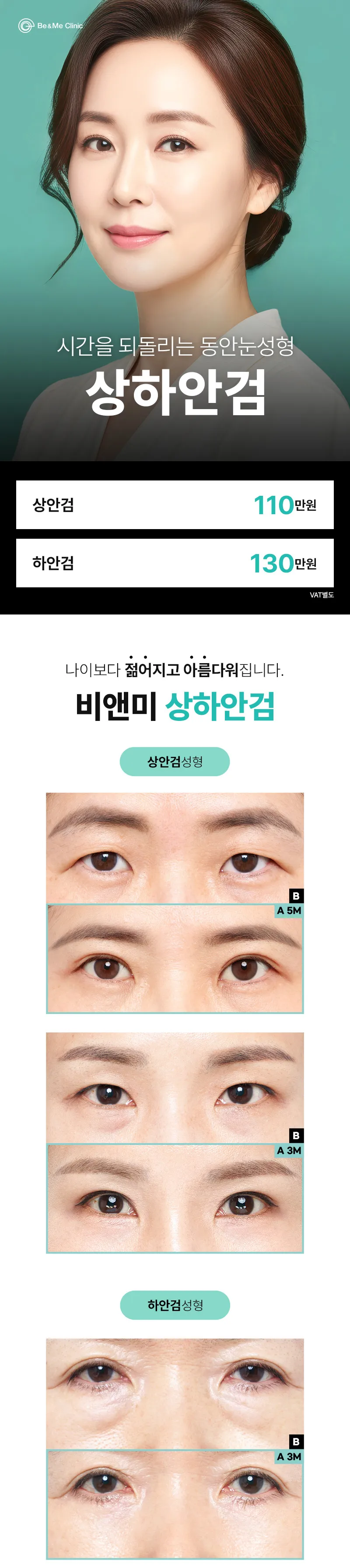 압구정비앤미의원 압구정비앤미 중년 상안검 하안검  이벤트, 시술 상세 이미지