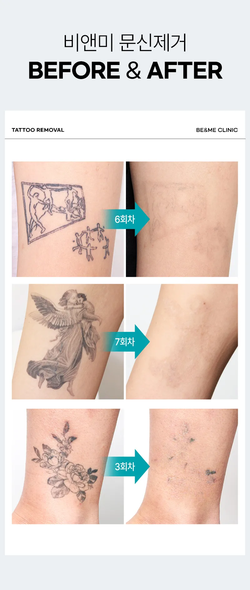 압구정비앤미의원 비앤미  타투 · 문신제거 깔끔하게  이벤트, 시술 상세 이미지