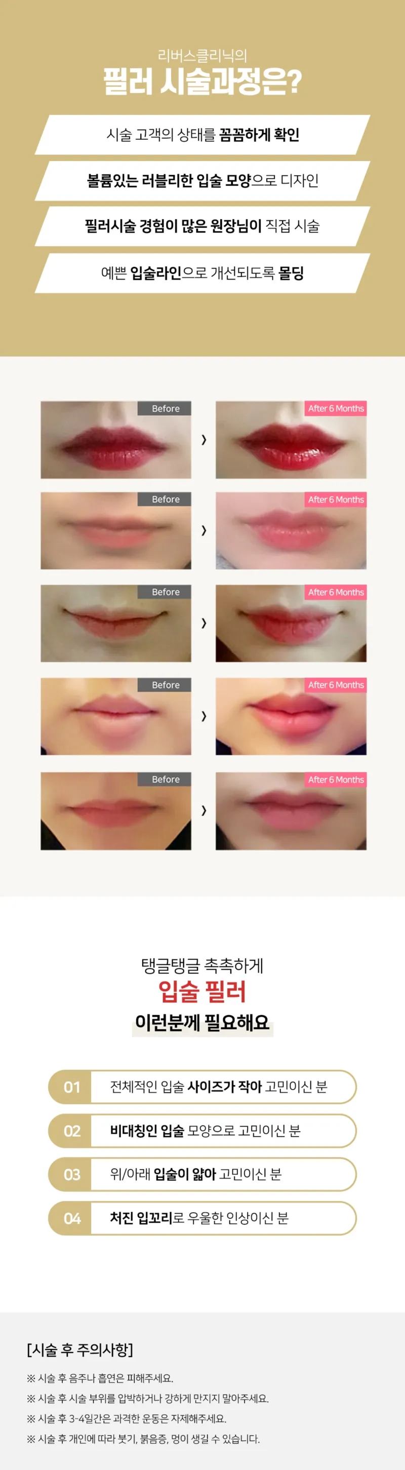 리버스클리닉 수원점 입술을 도톰하게 입술필러 이벤트, 시술 상세 이미지