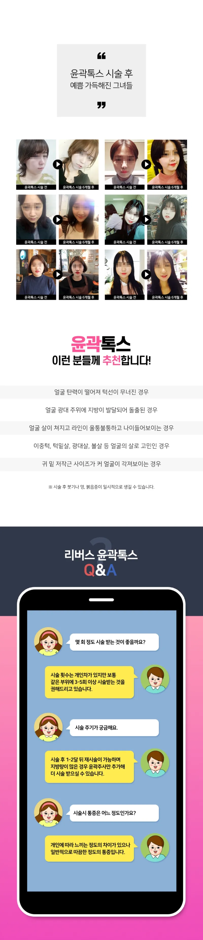 리버스클리닉 수원점 갸름한 V라인 윤곽톡스 이벤트, 시술 상세 이미지