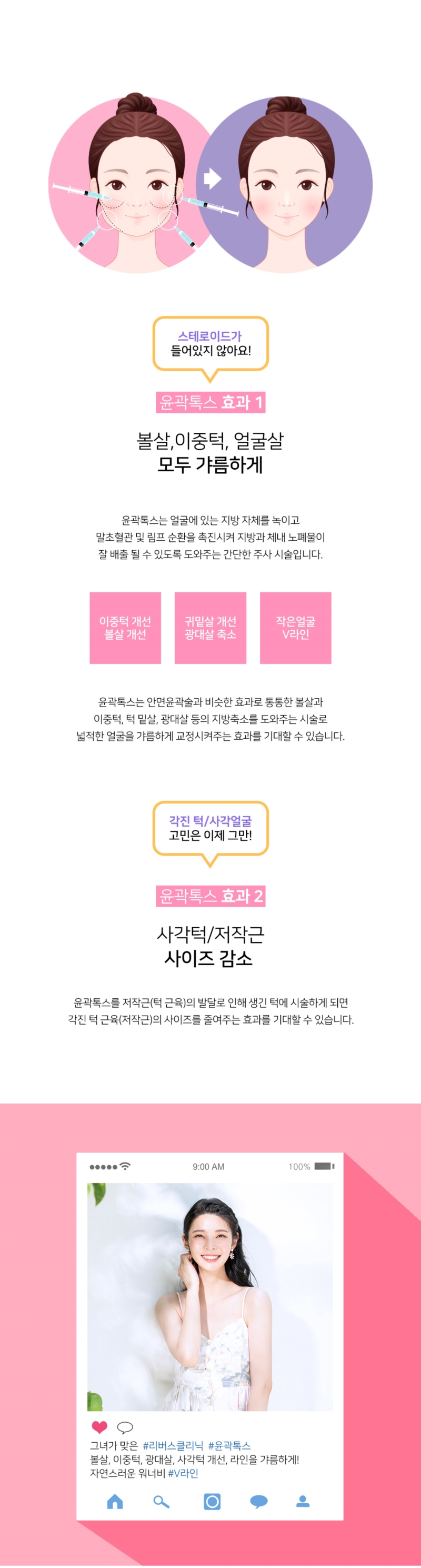 리버스클리닉 수원점 갸름한 V라인 윤곽톡스 이벤트, 시술 상세 이미지