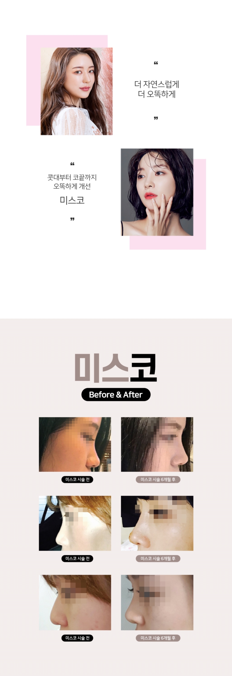 리버스클리닉 인천구월점 자연스럽고 오똑한 코는 미스코 이벤트, 시술 상세 이미지