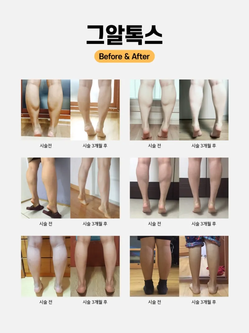 리버스클리닉 인천구월점 인천 종아리에서 발목까지 그알톡스 이벤트, 시술 상세 이미지