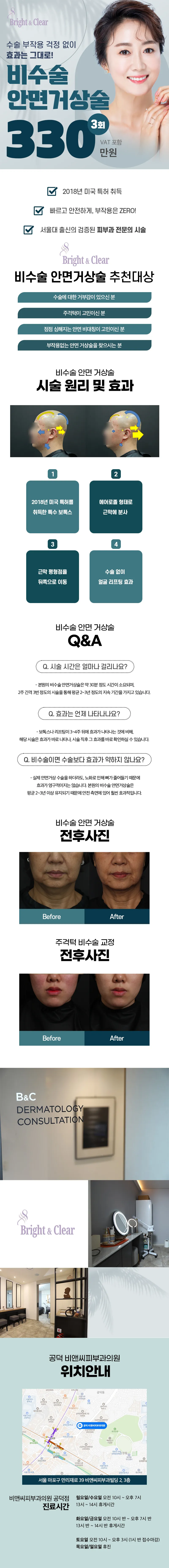 비앤씨피부과의원 공덕점 [공덕 비앤씨피부과]비수술 안면거상술 이벤트, 시술 상세 이미지