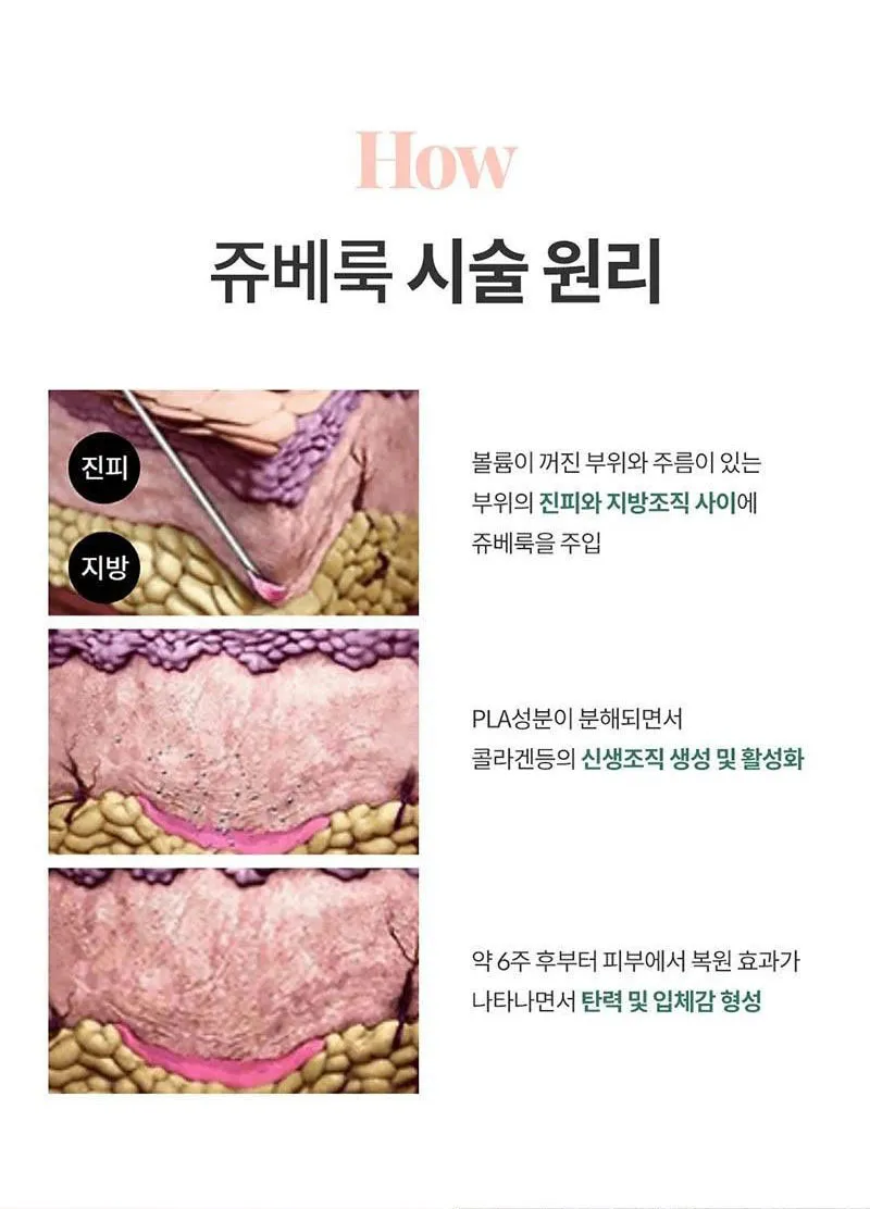 몬스터의원 쥬베룩 5CC 쥬베룩볼륨 이벤트, 시술 상세 이미지