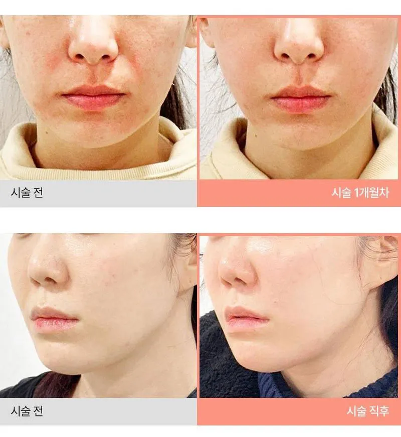 몬스터의원 쥬베룩 5CC 쥬베룩볼륨 이벤트, 시술 상세 이미지