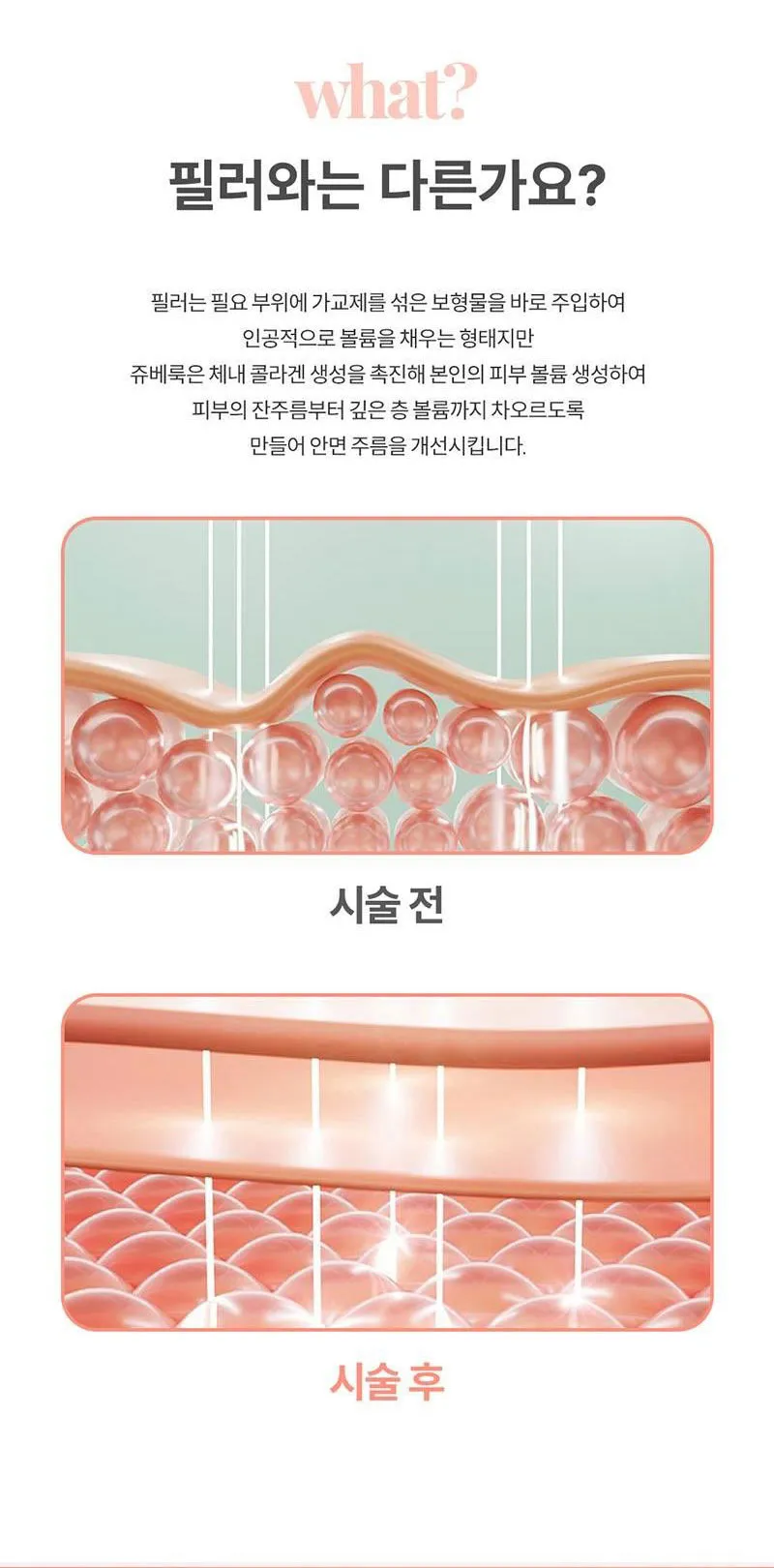 몬스터의원 쥬베룩 5CC 쥬베룩볼륨 이벤트, 시술 상세 이미지